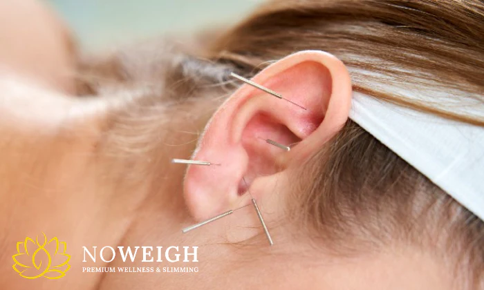 2 or 3 x Acudetox Acupuncture Sessions