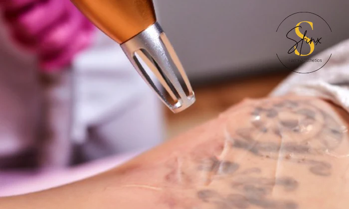 6 x Tattoo Removal Sessions