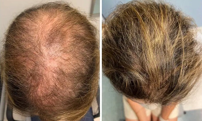 Boost Hair Growth & Scalp Health – Scalp Microneedling with Laser Sessions - Image 3
