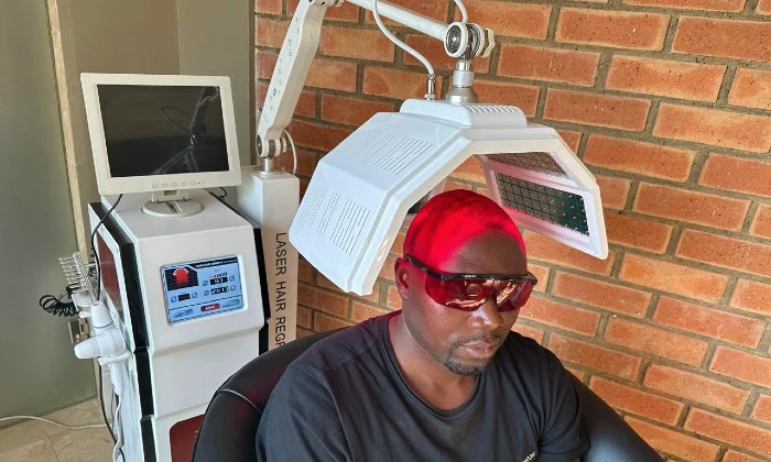 Boost Hair Growth & Scalp Health – Scalp Microneedling with Laser Sessions - Image 4