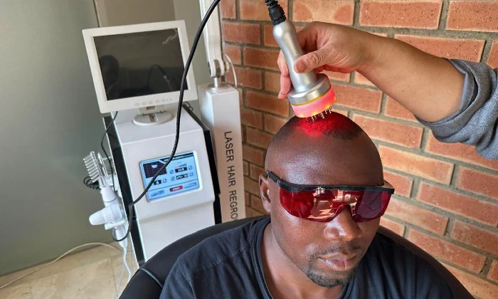 Boost Hair Growth & Scalp Health – Scalp Microneedling with Laser Sessions - Image 5