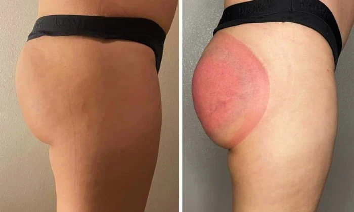 Butt Lift Sessions at Total Skin and Body - Image 3