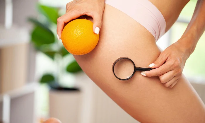 Cellulite Reduction Treatment Package at Royale Chic