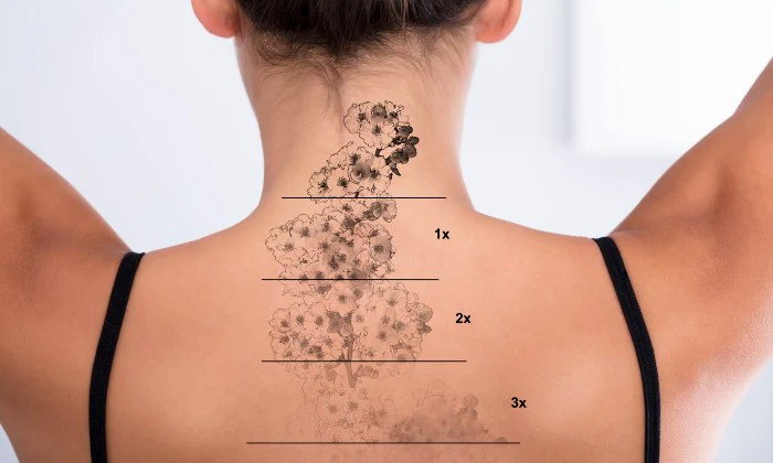 Choice of Tattoo Removal Sessions at Luxe Laser Studio