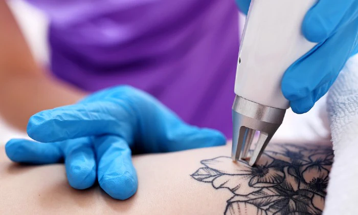 Choice of Tattoo Removal Sessions at Luxe Laser Studio - Image 3