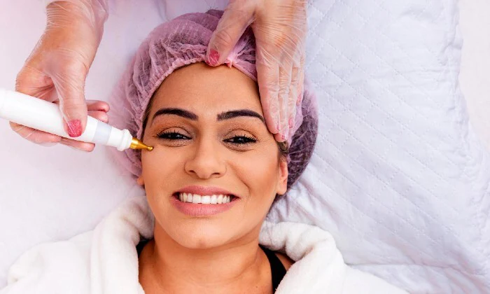 Microneedling Sessions with Chemical Peel - Image 2