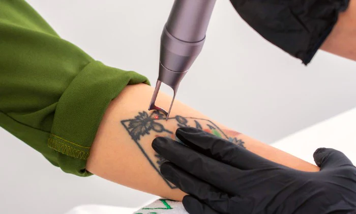 Tattoo Removal at Laser Clinic Medical