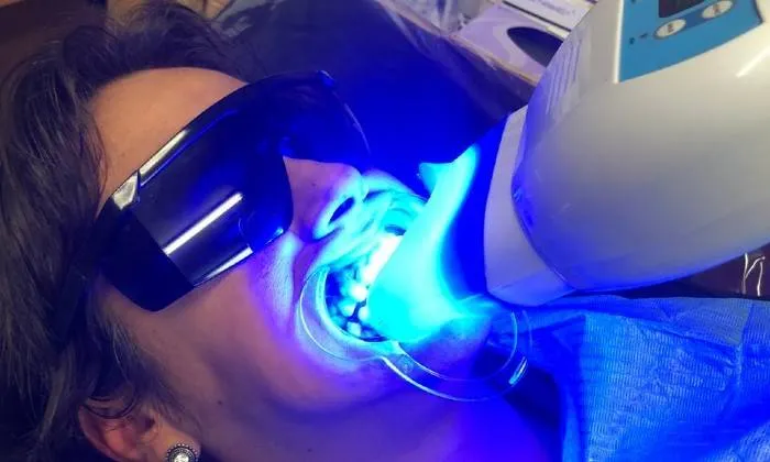 Teeth Whitening Session from La Glace Beauty Clinic - Image 6