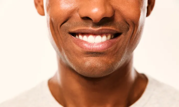 Teeth whitening sessions